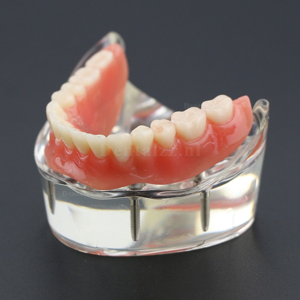 Demo-onderzoek tandheelkundige onderste tanden Model 6002 02 Overdenture Inferior 4 implantaten
